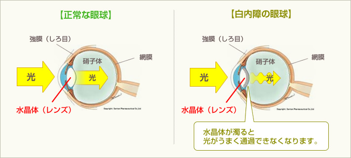 白内障　イメージ